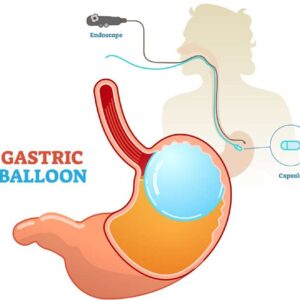 gastric balloon surgery