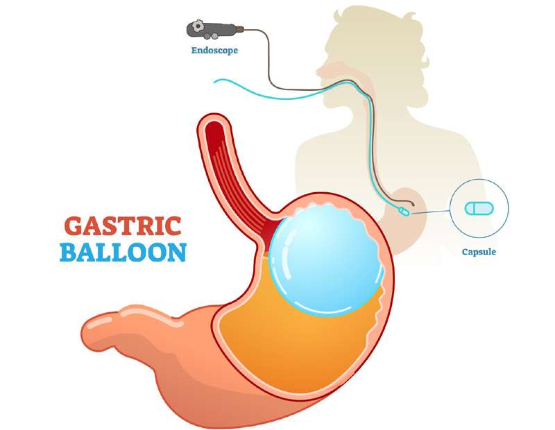 ENDOSCOPIC GASTRIC BALLON