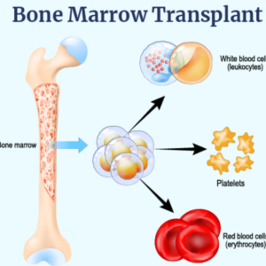 bone marrow transplant (bmt) - medical tourism