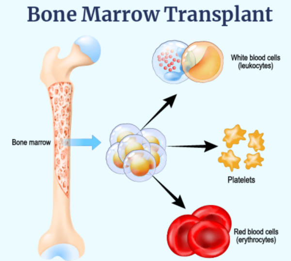 bone marrow transplant (bmt) - medical tourism