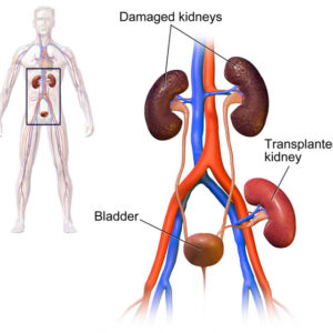 kidney transplant - memorial hospital