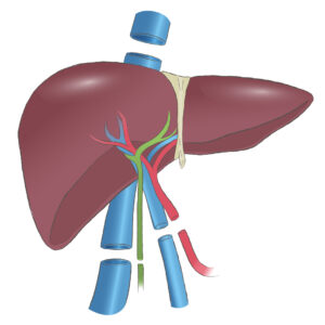 liver transplant surgery - medical tourism