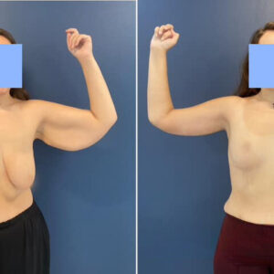 Arm Lift (Brachioplasty)