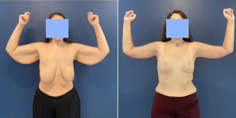 Arm Lift (Brachioplasty)