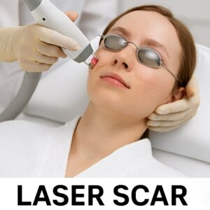 Fractional CO₂ laser targeting stubborn acne scars