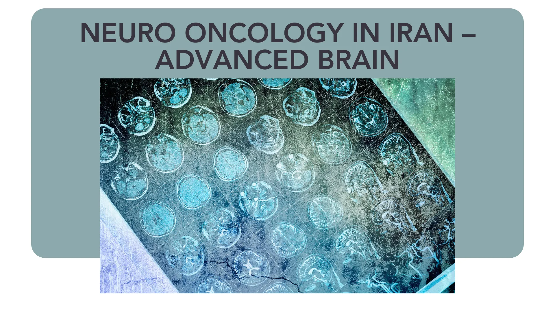 Neuro Oncology in Iran – Advanced Brain & Spinal Cancer Treatment