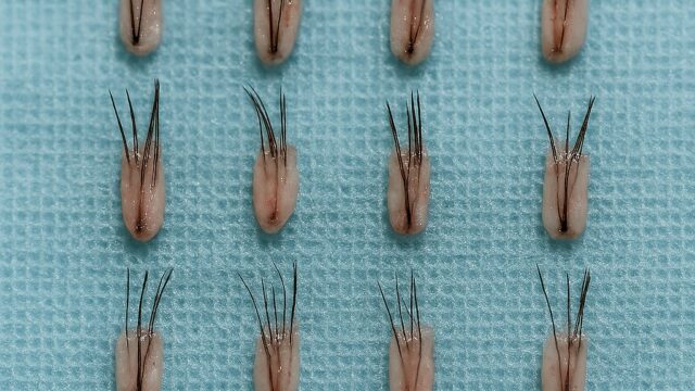 Microscopic view of hair transplant grafts arranged on a tray
