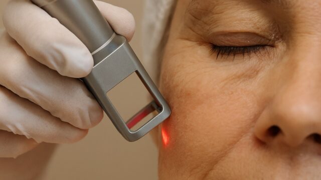 Close-up of CO2 laser skin resurfacing treatment on a woman's face, highlighting wrinkle reduction
