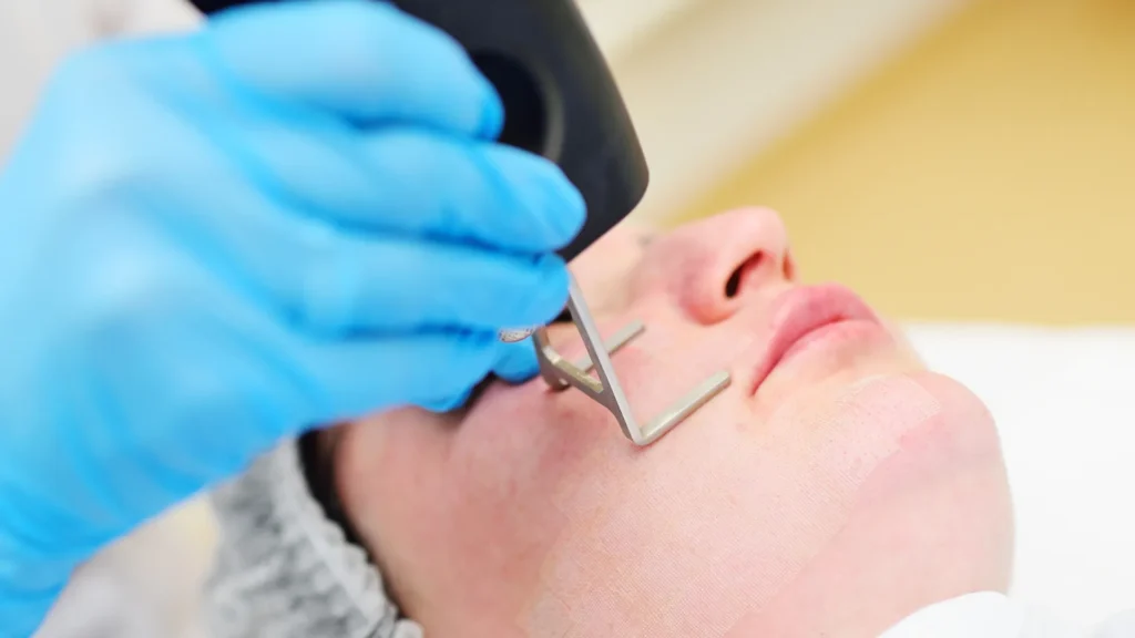 Why Fractional Laser Treatment is Popular in Medical Tourism