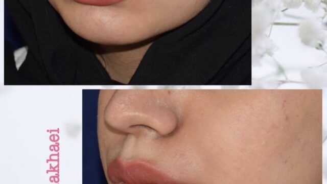 Jawline Contouring Dr nakhaei