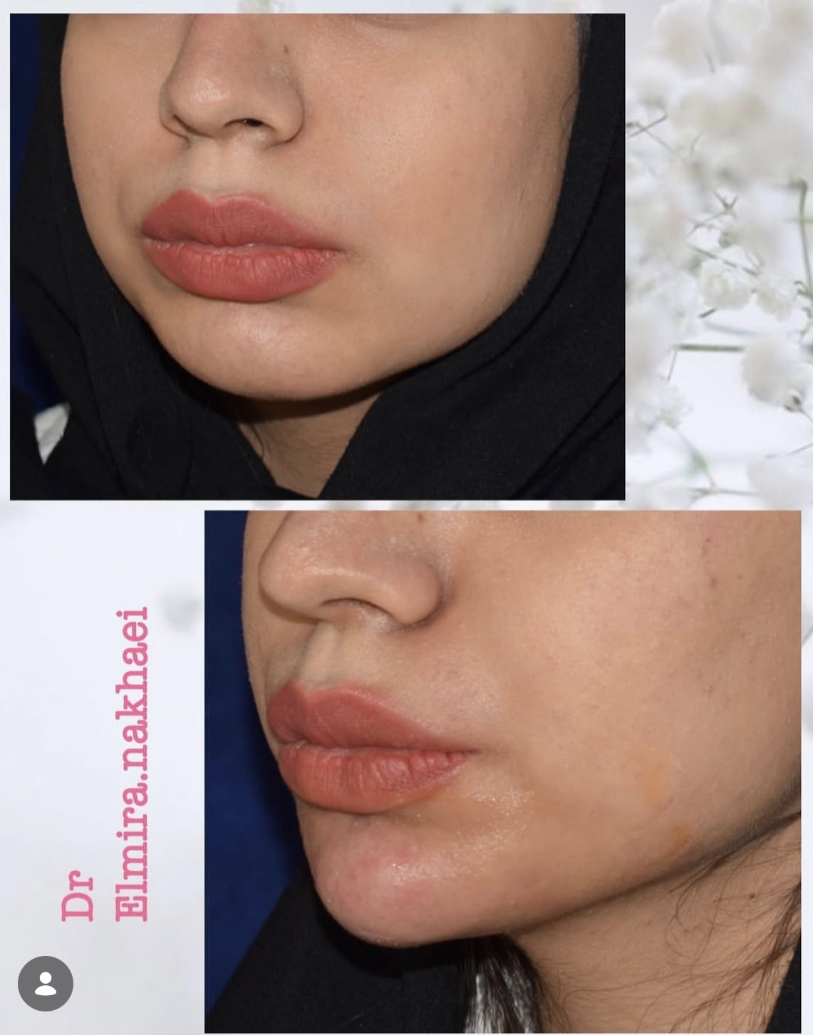 Jawline Contouring Dr nakhaei