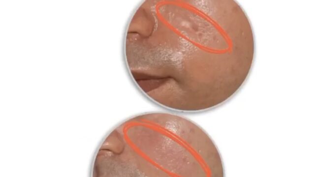 Achieve smoother skin with expert scar revision following a wound. Explore advanced surgical & non-surgical treatments with Dr. Nakhaei.