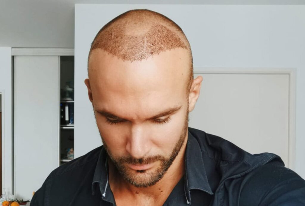 hair-transplant-recovery