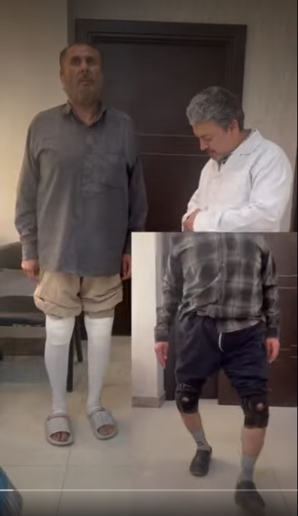 Corrective Leg Deformity Surgery Recovery real sample