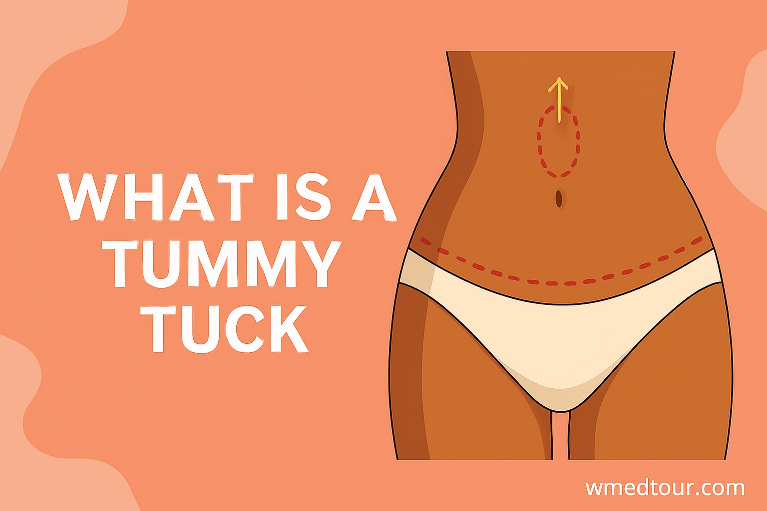 Medical illustration showing tummy tuck incision lines, navel repositioning, and abdominal contouring on a female torso.