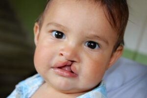 Cleft Lip