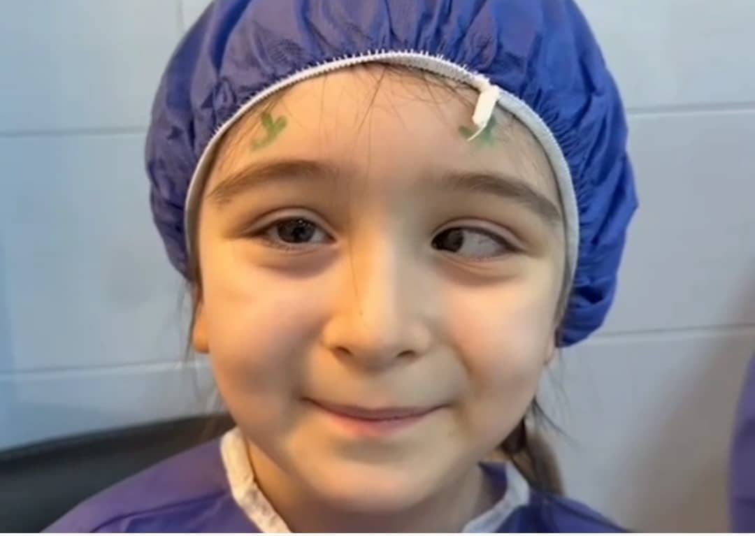 Strabismus (Squint) Correction Surgery