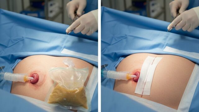 A side-by-side medical illustration of a patient’s abdomen post-surgery. The left side, labeled "ILEOSTOMY," shows a surgical stoma with an external drainage bag attached. The right side, labeled "NO ILEOSTOMY," shows a clean surgical incision closed with medical adhesive strips and no external bag.